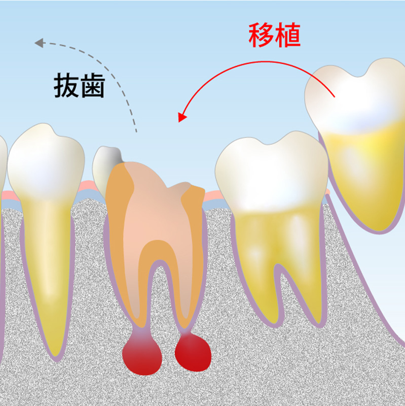 自家歯牙移植術とは